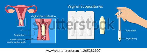 Vaginal Yeast Infections Treatment Applicator Symptoms Stock Vector