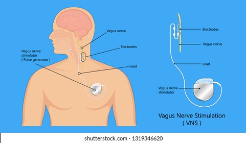 Vagus nerve stimulation device stimulate electrical impulse implantable stimulator treat epilepsy depression electroconvulsive therapy