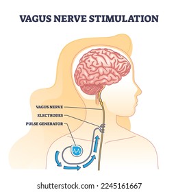 Estimulación de los nervios de Vagus como implante de dispositivo médico para el diagrama de esquema cerebral. Esquema etiquetado con generador de pulso de señal eléctrica o electrodos para ilustración vectorial de tratamiento de epilepsia o depresión