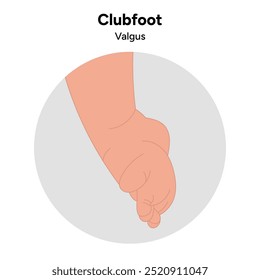 Valgus Clubfoot problema pé. Diagrama infográfico ortopédico