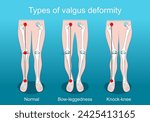 valgus deformities. Knee deformity. healthy joint, knock-knee and Bow-leggedness. Human legs, bones and joints. Corrective surgery. Vector poster. Isometric Flat illustration.