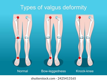 valgus deformities. Knee deformity. healthy joint, knock-knee and Bow-leggedness. Human legs, bones and joints. Corrective surgery. Vector poster. Isometric Flat illustration.