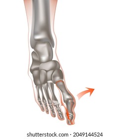 Valgus-Deformität des großen Zehens. Knochen auf den Füßen oder Bumps auf den Füßen, Gicht. Abweichung des großen Zehens, zuerst nach außen. Anatomie von Gelenken und Knochen. Vektorgrafik