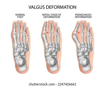 Valgus deformity of the toes. Vector illustration.