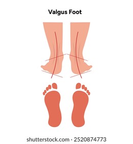 Pé e pegada de Valgus. Diagrama ortopédico infográfico