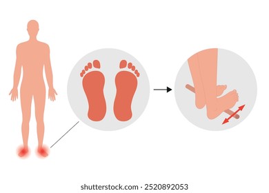 Problema do pé Valgus. Exercícios especiais para o problema da deformação dos alimentos. Ortopedista Pé terapêutico e fortalecedor com vara