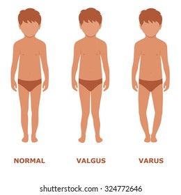 valgus, varus knee, legs disease, foot illustration