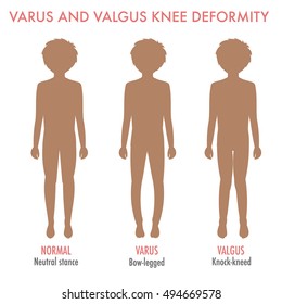 Valgus, varus knee, legs disease, deformation infographic. Boy silhouette with normal leg stance, valgus, varus. Shape of the legs: genu varum, genu valgum. Legs deformity and bowing. Vector isolated.