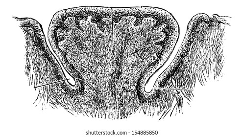 Papilla vallada de la lengua humana, con gran magnificación, ilustración vintage grabada. Diccionario de medicina habitual del Dr. Labarthe - 1885