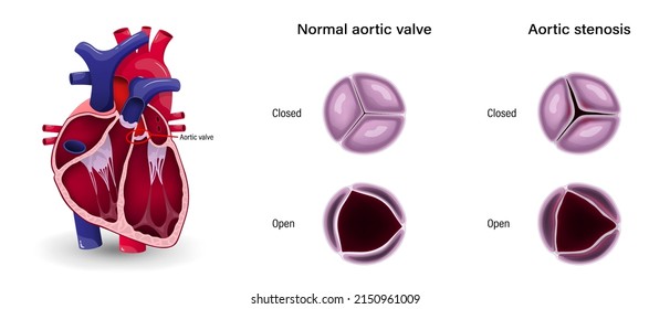 Valular heart disease. The difference of aortic stenosis and normal aortic valve.