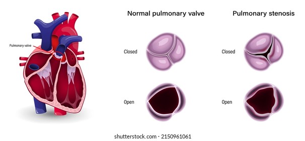 Valular Heart Disease. The Difference Of Pulmonary Stenosis And Normal Pulmonary Valve.