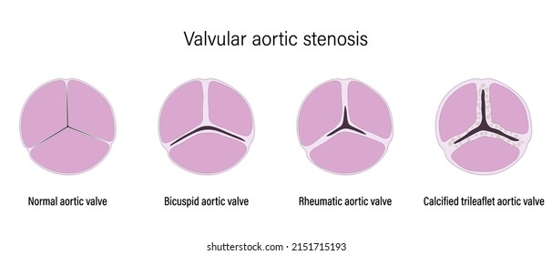 Valvular aortic stenosis. Normal, Bicuspid , Rheumatic and Calcified trileaflet aortic valve.
