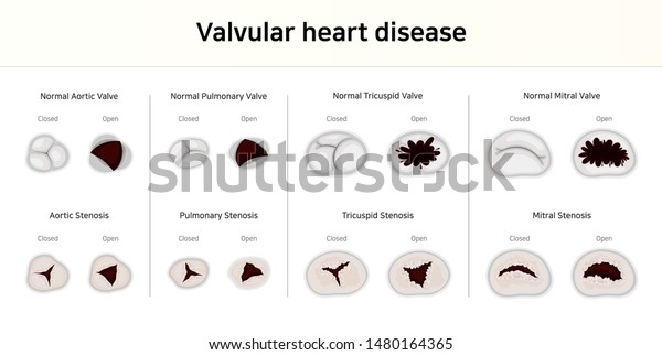 Valvular heart disease.\
Valve stenosis