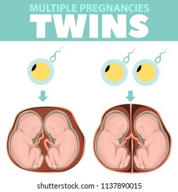 Variants of cell division under twins. Infographics. Detailed vector Infographic. Baby Health