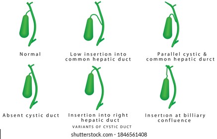 Variants Of Cystic Duct. Common Variations In Biliary Anatomy. Variations In Cystic And Hepatic Ducts. Human Gallbladder, Gallbladder Connection To The Bile Ducts. Pathology Of The Gallbladder