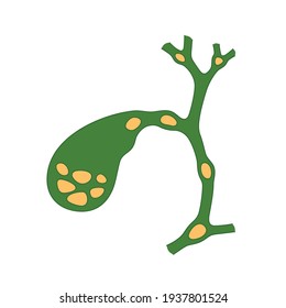 Variants of the location of stones in the gallbladder and bile ducts. Schematic drawing for cholelithiasis, gallstone disease. Isolated vector illustration on white background