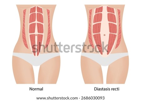 Variations of diastasis recti. Separation of the muscles
