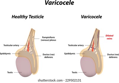 Varicocele