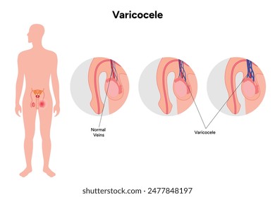 Estadio de varicocele y vena normal 