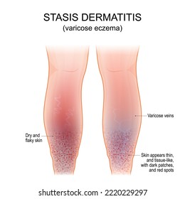 Varicose Eczema. Symptoms Of Venous, Gravitational Or Stasis Dermatitis. Long-term Skin Condition That Affects The Lower Legs With Varicose Veins. Vector Poster