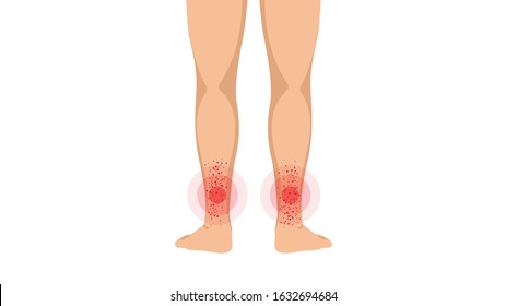 Varicose in the legs. Vascular or spider veins. Vector illustration.