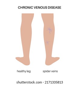 Varicose spider veins concept. Swelling and pain in human legs. Vascular disease diagnostic and treatment. Abnormal blood pressure, weak vein and valves. Venous insufficiency flat vector illustration.