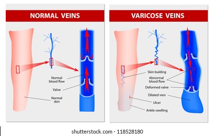 Varicose vein forms in a leg. Normal vein and varicose vein. Vector