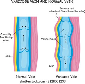 varicose vein and normal vein , medical illustration, flat vector diagram
