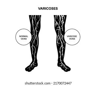 Varicose veins concept. Swelling and pain in human legs. Vascular disease diagnostic and treatment. Abnormal blood pressure, weak vein and valves. Venous insufficiency medical flat vector illustration