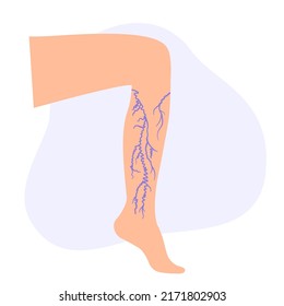 Varicose veins concept. Swelling and pain in female legs. Vascular disease diagnostic and treatment. Abnormal blood pressure, weak vein and valves. Venous insufficiency medical vector illustration