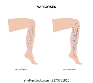 Varicose veins concept. Swelling and pain in female legs. Vascular disease diagnostic and treatment. Abnormal blood pressure, weak vein and valves. Venous insufficiency medical vector illustration