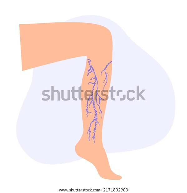 Varicose veins concept. Swelling and pain in\
female legs. Vascular disease diagnostic and treatment. Abnormal\
blood pressure, weak vein and valves. Venous insufficiency medical\
vector illustration