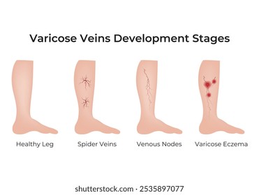 Diagrama de Ilustración vectorial de diseño de Ciencia de etapas de desarrollo de venas varicosas