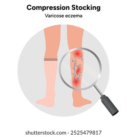 Eczema das veias varicosas. Meias de compressão veias