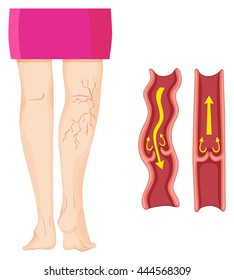 289 Veins legs draw Images, Stock Photos & Vectors | Shutterstock