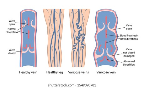 Varicose veins. Image of healthy and diseased legs. A longitudinal section of a vein with a description of the main parts. Vector illustration in flat style