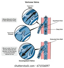 Varicose Veins infographic diagram showing the normal valve open and closed and compare it to incompetent valve which fails for medical science education and health care