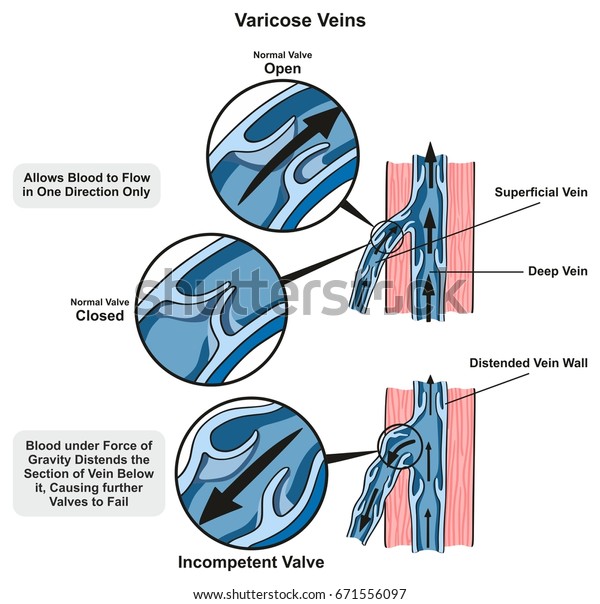 Science varicoză, Varicoza reticulară a simptomelor extremităților inferioare