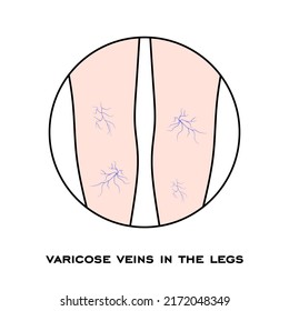 Varicose veins in the legs. Varicose spider veins anatomy. Swelling and pain in human legs. Vascular disease diagnostic and treatment. Abnormal blood pressure, weak vein and valves. vector