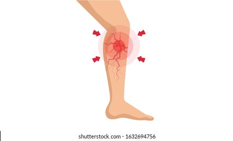 Varicose veins in the legs. Vascular or spider veins. Vector illustration.