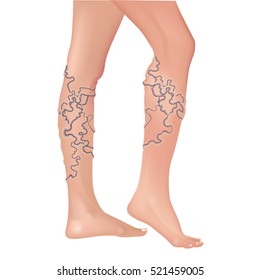 Varicose veins in the legs. Vector illustration.