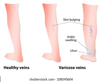Varicose veins are twisted and enlarged veins blue in color linked to faulty valves. In some of the cases, the veins may go on to rupture or ulcers may form. Vector diagram