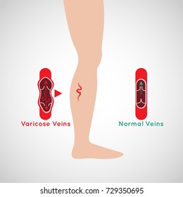 Varicose Veins Vector Logo Icon Illustration