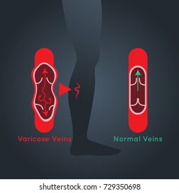 Varicose Veins vector logo icon illustration