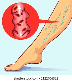 Varicose viens, vector illustration