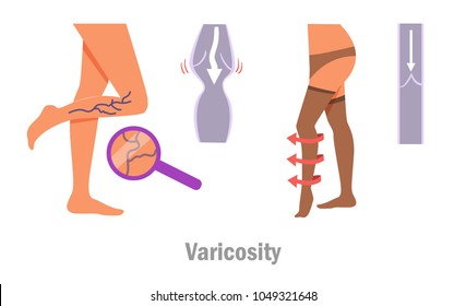 Varicosity. Legs. Vector. Cartoon. Isolated art on white background. Flat