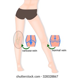 Varicosity. Normal vein and varicose vein