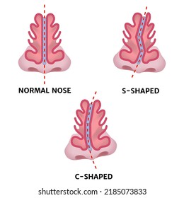 Varieties of curvature of the nose. Medical poster. Vector illustration