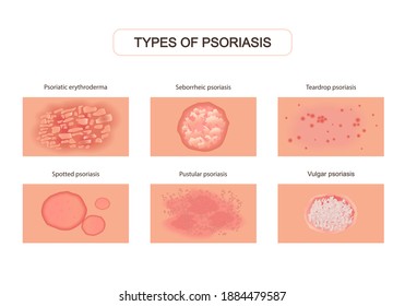 Varieties of psoriasis set. Red eruptions on skin with ulcers and itching damage upper layers of epidermis with allergies severe neurological disease with pustular abscesses. Pathological vector.