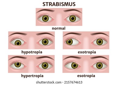 Varieties of strabismus. Eye disease infographic. Medical poster. Vector illustration